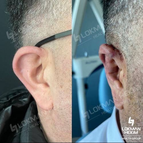 Ear correction surgery (Otoplasty) Before / After photo